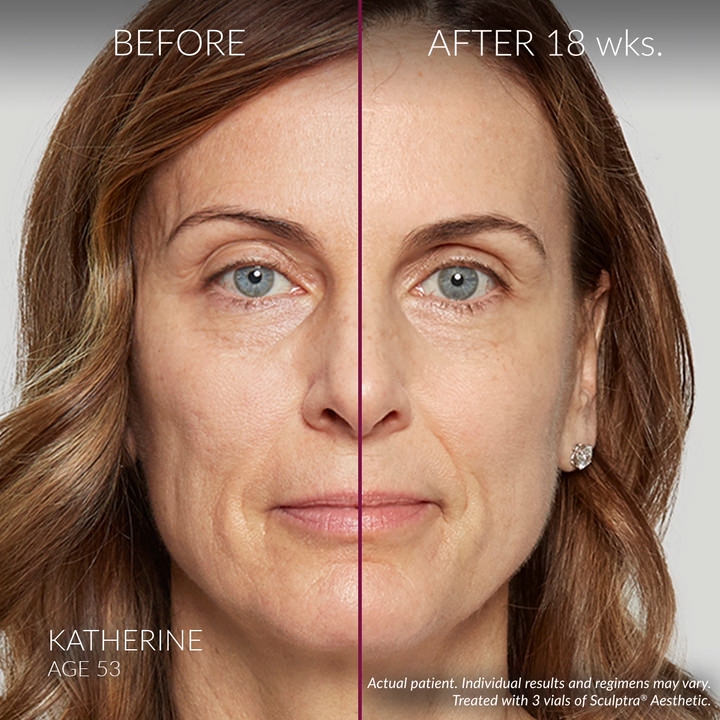 sculptra-7648678